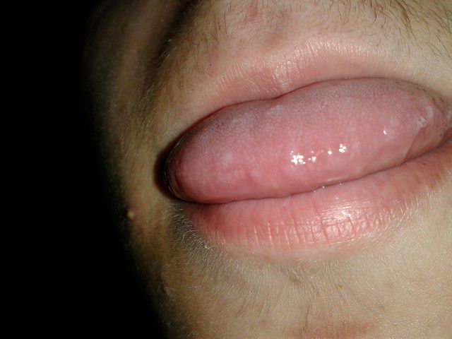 У ребенка на языке белые пупырышки как лечить У ребенка на языке белые пупырышки как лечить