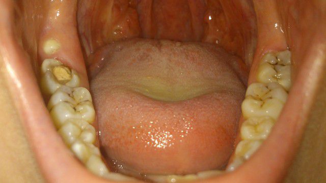 Симптомы гнилых зубов