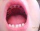 Можно ли удалить зуб при стоматите у ребенка