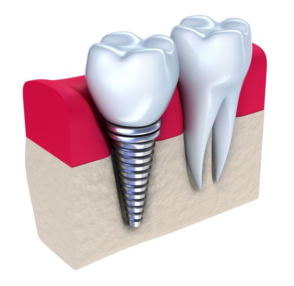 Имплантация позволяет полностью заменить отсутствующие зубы