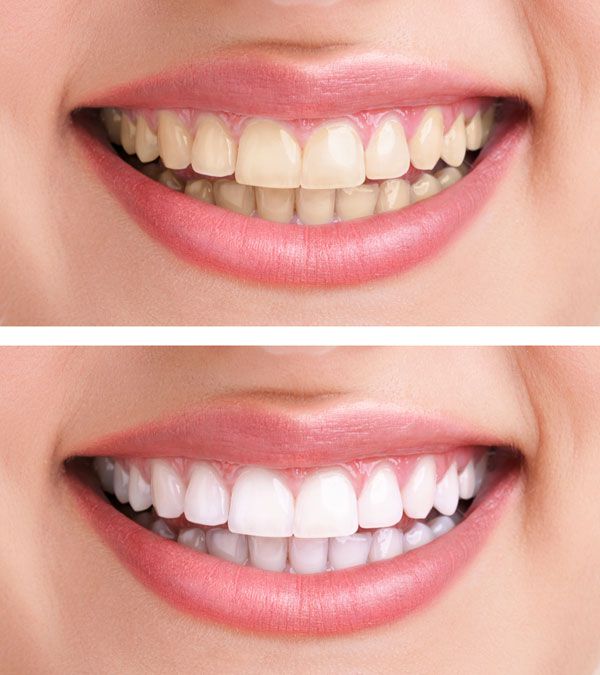 Отбеливание зубов является популярной и эффективной процедурой