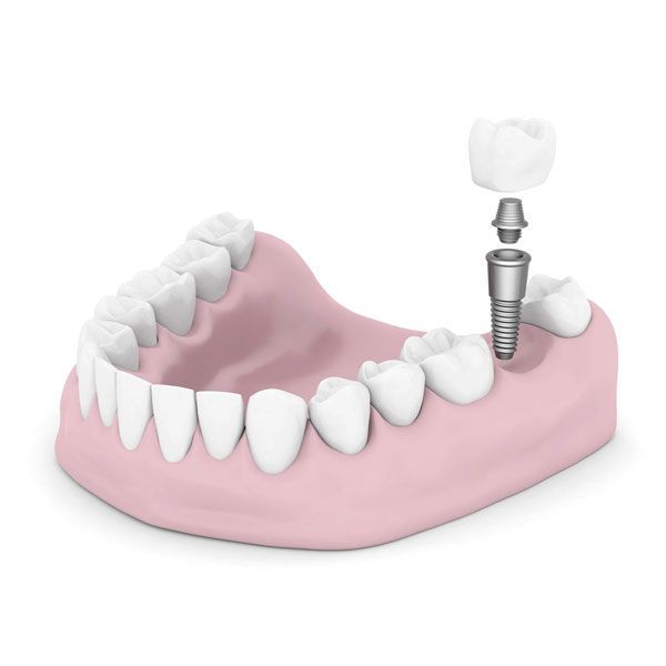 Имплантация предлагает полноценную замену отсутствующего зуба